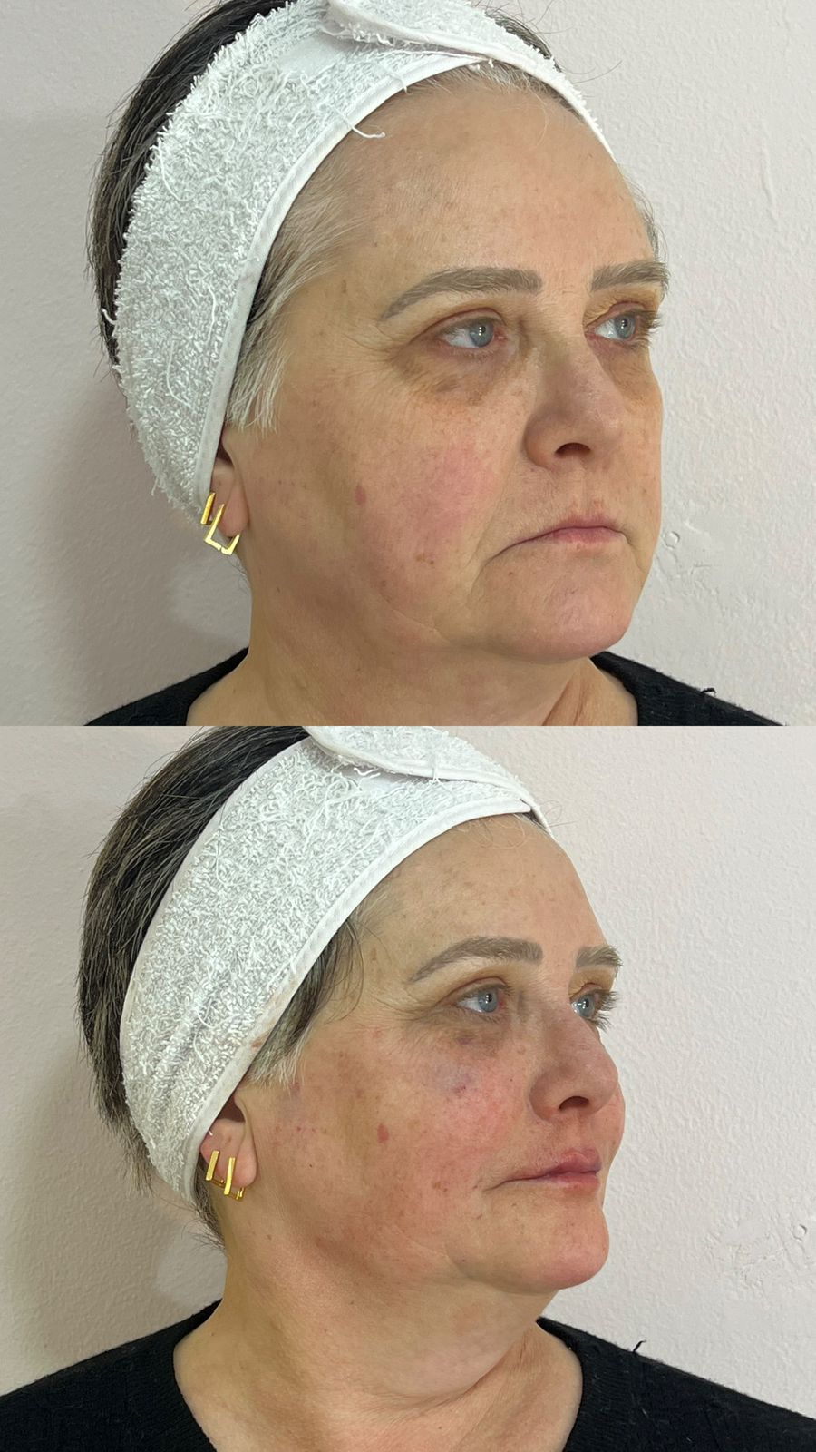 Resultado após harmonização facial — caso 1