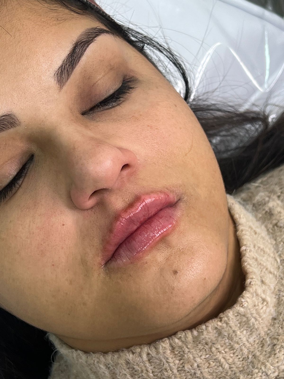 Antes do tratamento de pele — caso 2