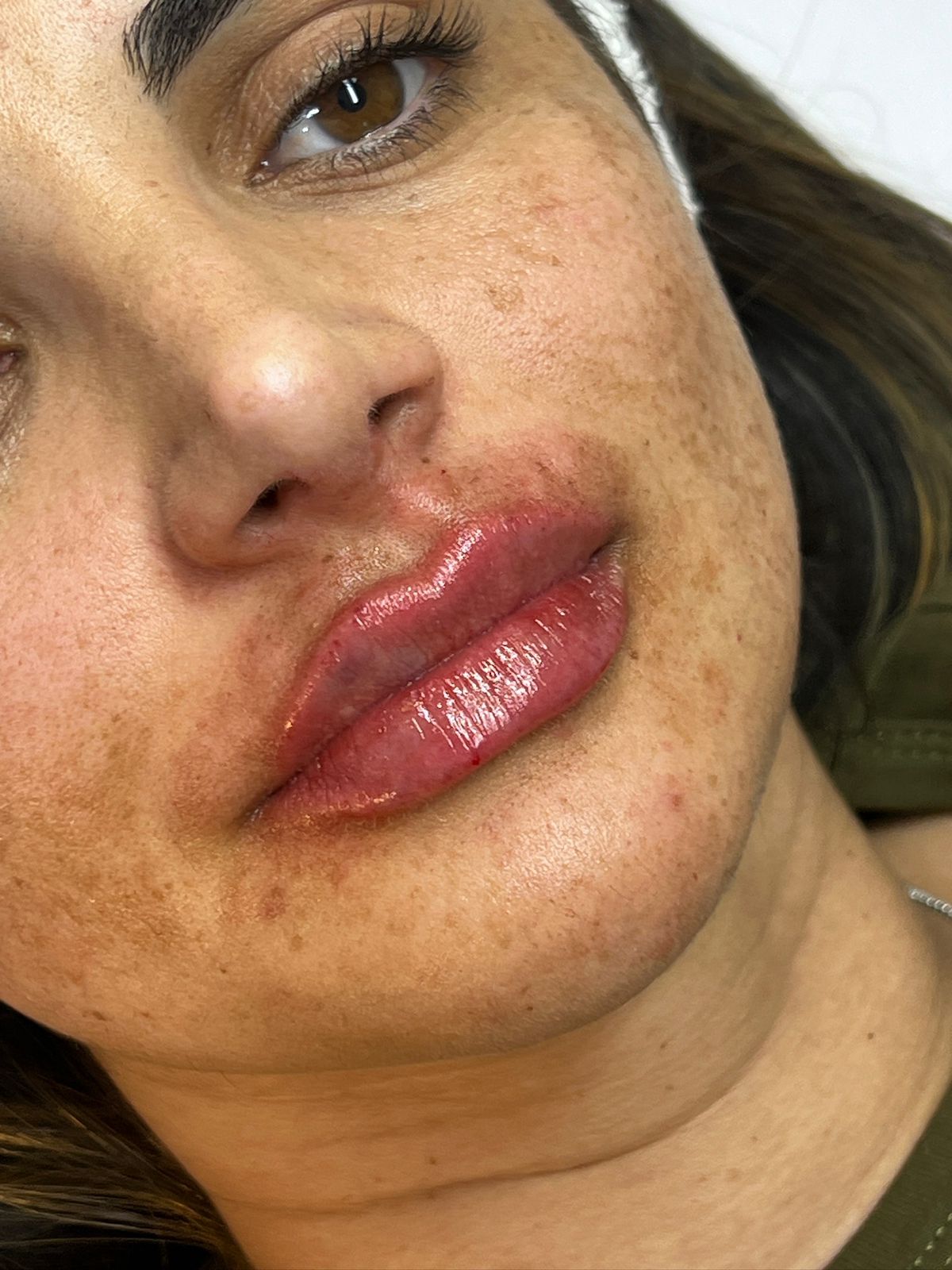 Resultado após tratamento de pele — caso 2