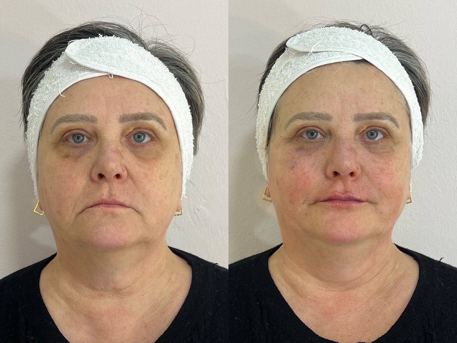 Antes do rejuvenescimento facial — caso 3