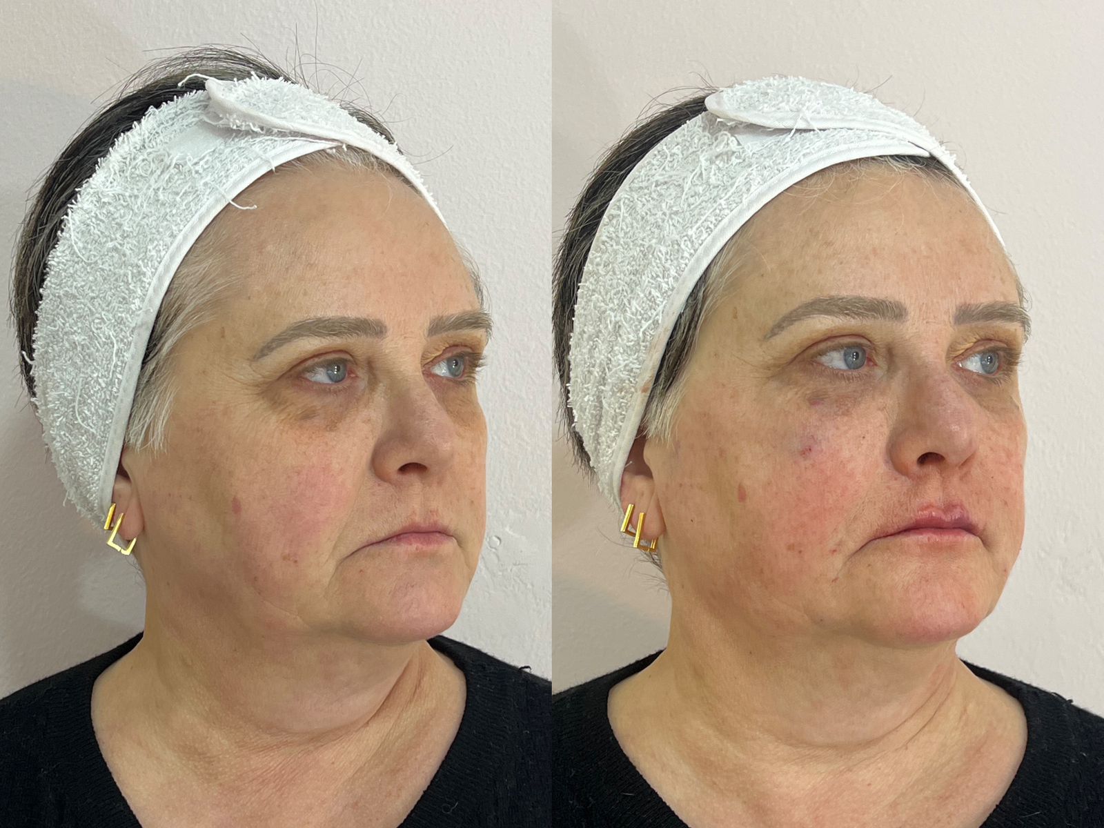 Resultado após rejuvenescimento facial — caso 3