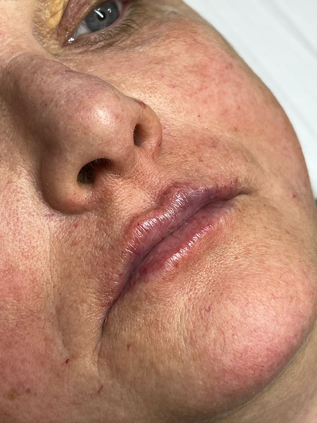 Antes do procedimento estético — caso 4