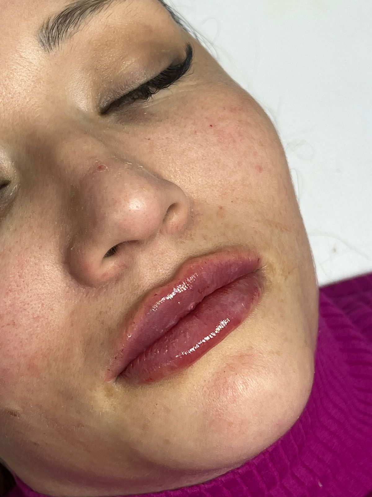 Resultado após procedimento estético — caso 4