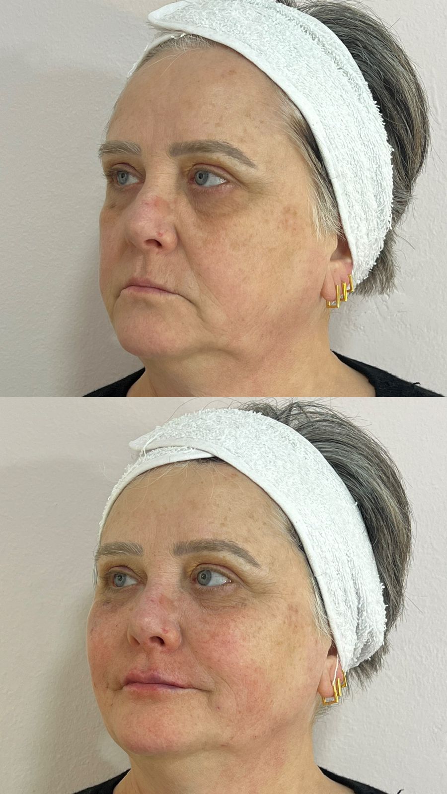 Antes do tratamento de saúde da pele — caso 5