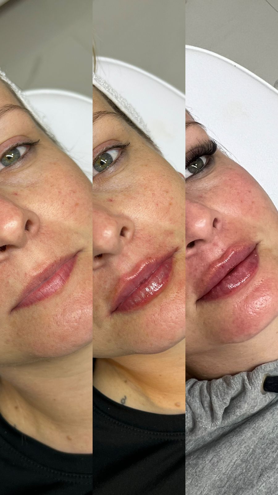 Resultado após tratamento de saúde da pele — caso 5