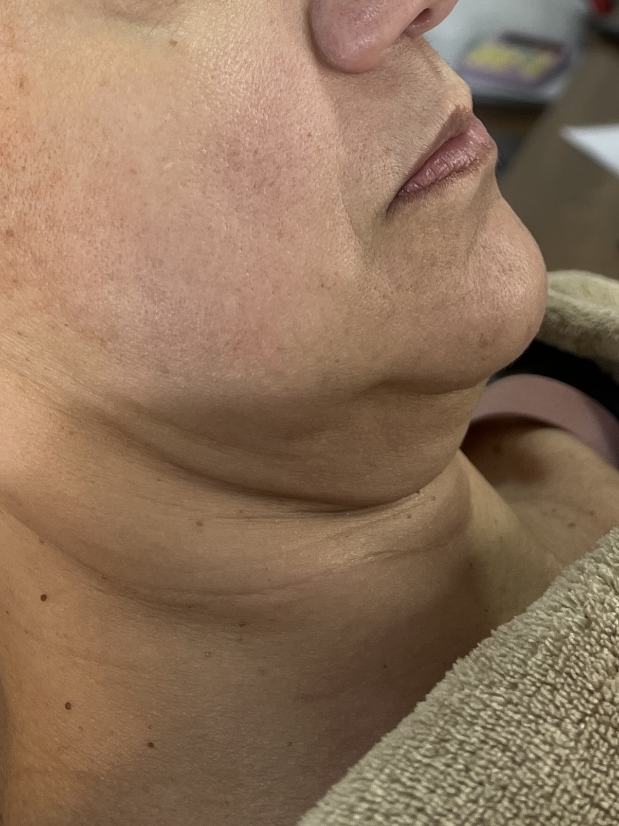 Antes do preenchimento labial