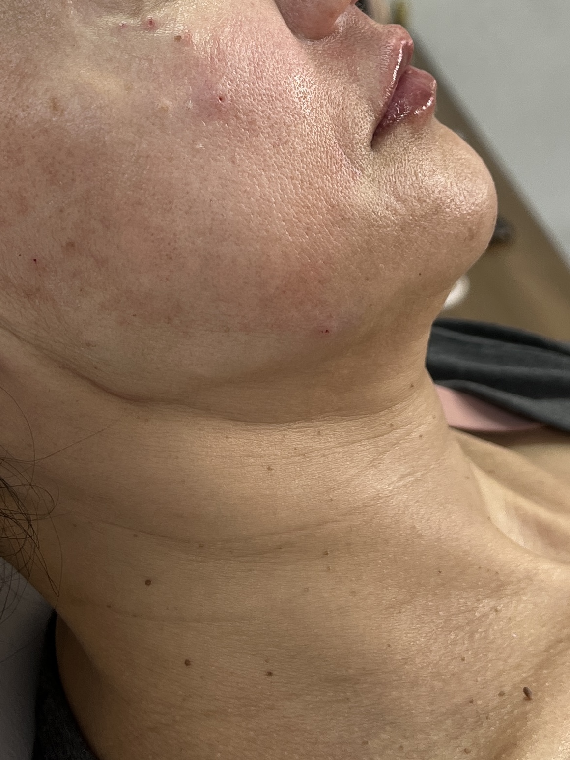 Depois do preenchimento labial