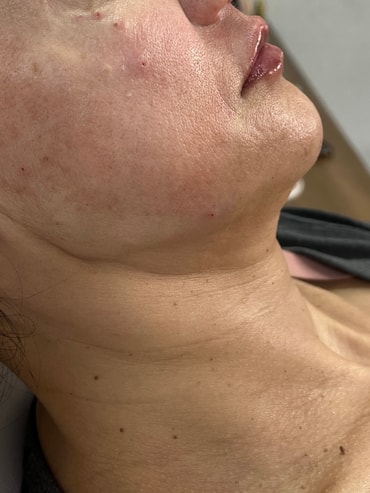 Depois do preenchimento labial